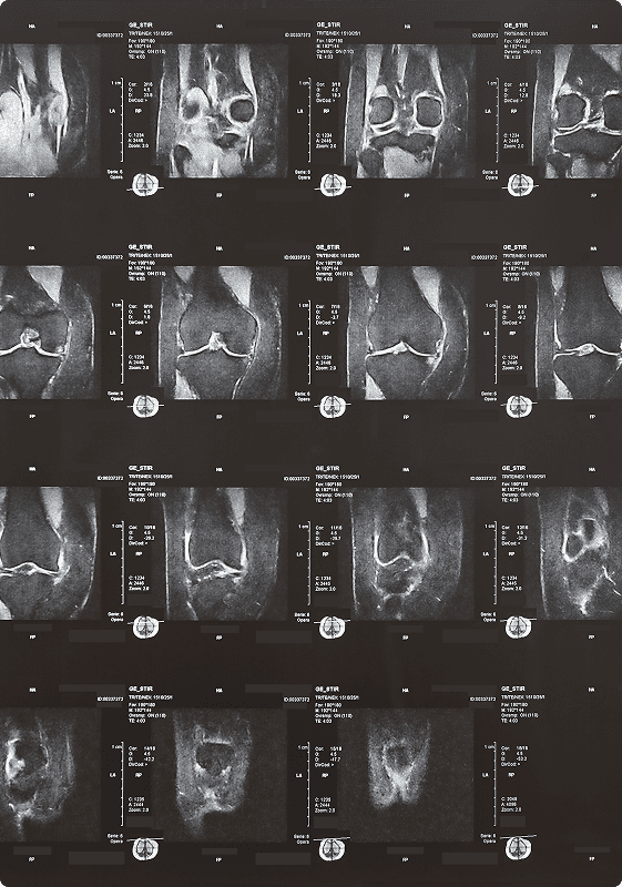 Patellar Instability Patellar Instability